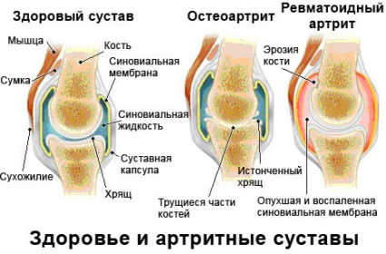 Какви заболявания водят до болка в ставите на краката