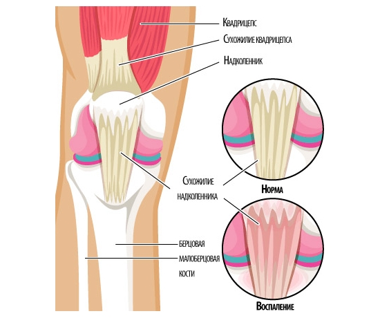 Атрибути на тендонит на колянната става и начини за нейното лечение