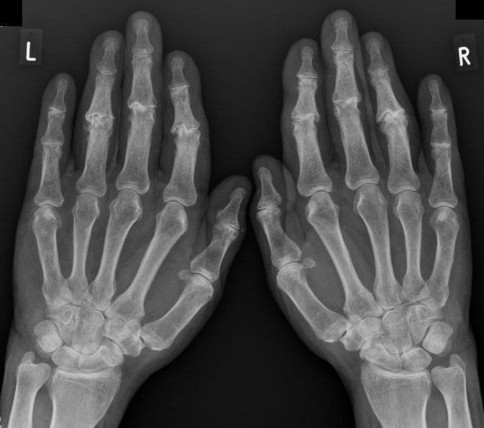 Причините за възпаление на лигаментите на ръката и как да се лекува?
