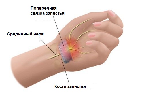 Причините за възпаление на лигаментите на ръката и как да се лекува?