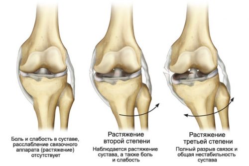 Увреждане на предния и задния кръстосан сухожилие на колянната става