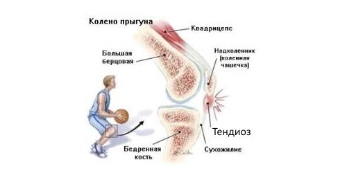 Характеристики на проявлението и лечението на сухожилията на сухожилията