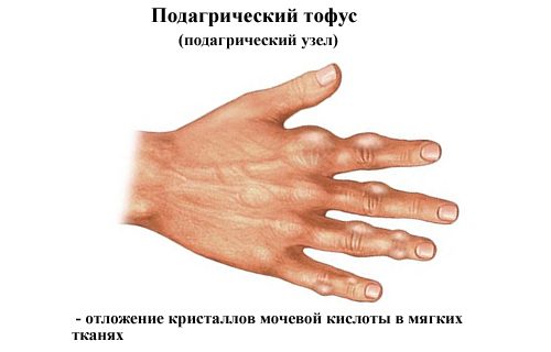 Характеристики на лечение на възпаление на сухожилията на ръката