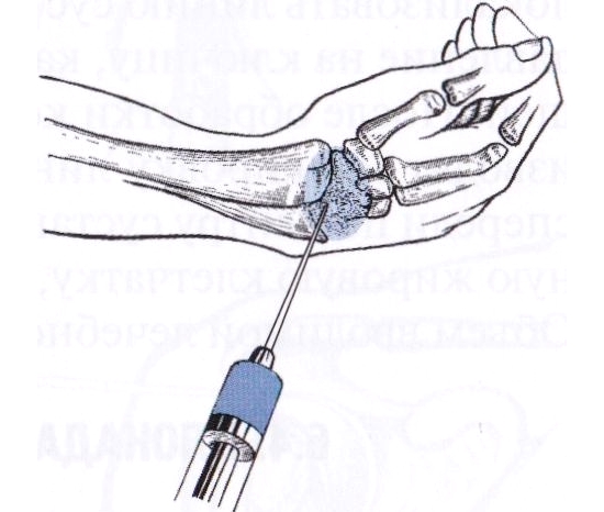 Характеристики на лечение на възпаление на сухожилията на ръката