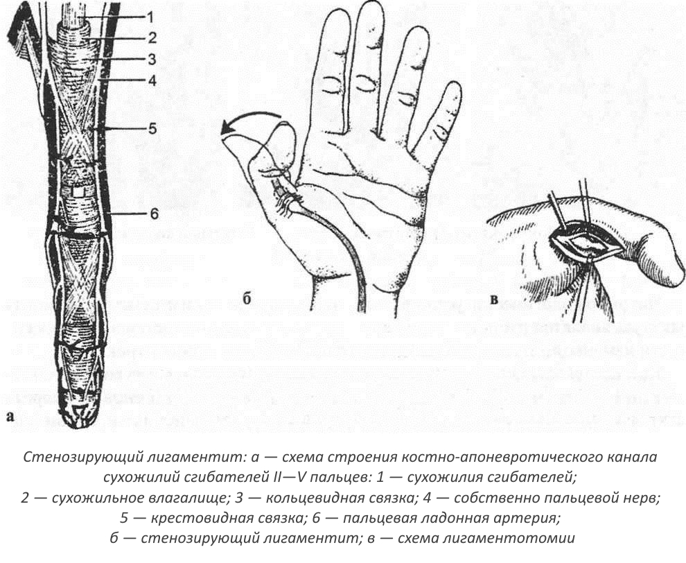 Проявление на синдром на счупвания пръст и неговото лечение