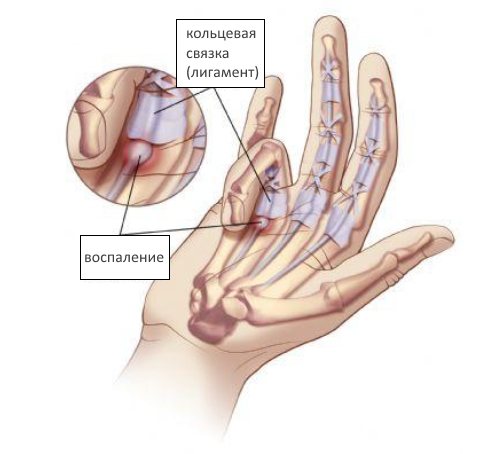 Проявление на синдром на счупвания пръст и неговото лечение