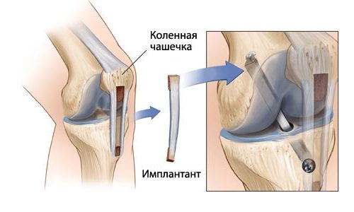 Пластмаси на предния кръстосан лигамент на коляното