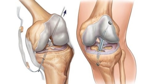 Пластмаси на предния кръстосан лигамент на коляното