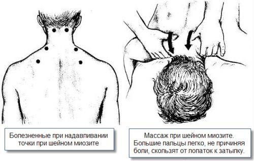 Причините за миозит на рамото и неговото лечение