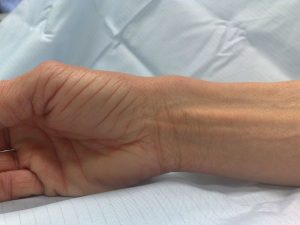 Лечение на ръката с тендовагинит на сухожилията