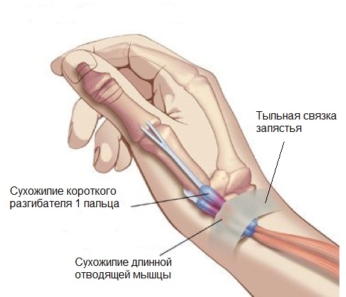 Лечение на ръката с тендовагинит на сухожилията