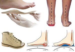 Как да изберем ортопедични обувки за деца с деформация на валгус на крака
