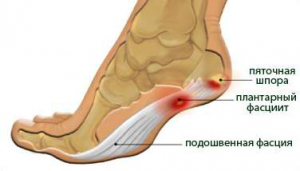 Стелки FormTotix - надеждна основа за краката, ставите и гръбначния стълб