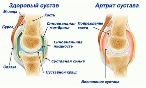 Как да изберем правилната превръзка за колянната става?