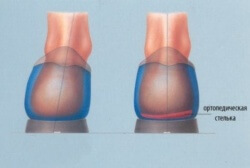 Отзиви за ортопедични стелки за деформация на валгус