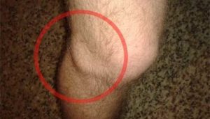 Диагностика и лечение на киста на менискуса на коляното