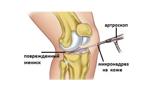 Диагностика и лечение на киста на менискуса на коляното