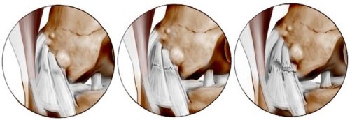 Народно лечение на навяхването на колянната става