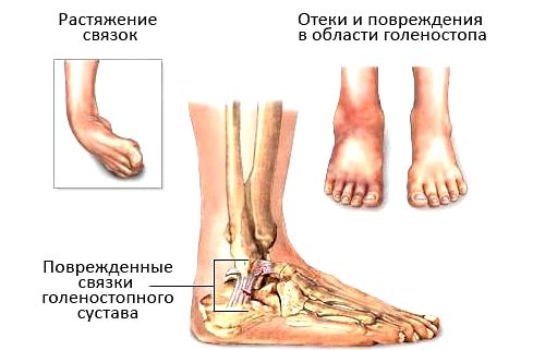 Как е тиапорованските крака с навяхвания?