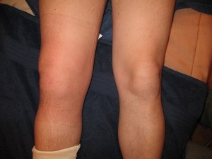 Проява на разкъсване на връзките на колянната става и нейното лечение