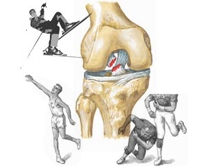 Признаци и лечение на навяхвания на колянната става