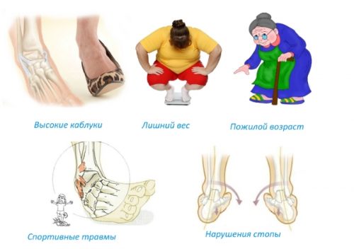 Признаци за разкъсване на връзките на крака и характеристики на лечението