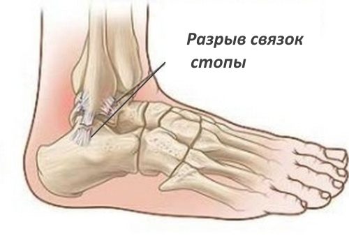Признаци за разкъсване на връзките на крака и характеристики на лечението