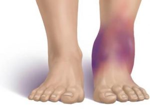 Признаци за разкъсване на сухожилията на крака и характеристики на лечението