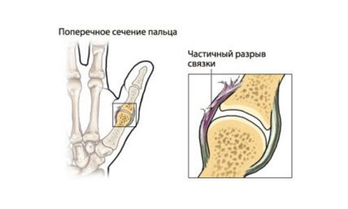 Признаци на изкълчване на сухожилията на палеца и други пръсти