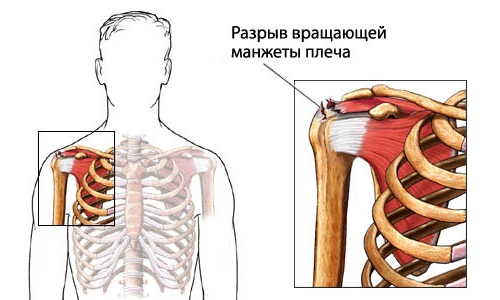 Знаци за повреда на ротационния маншет на рамото