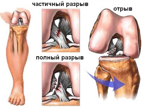 Симптоми на дегенеративни увреждания на менискуса на коляното