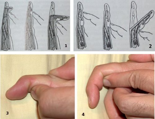 Какво да направите, ако сухожилието се счупи на пръста?