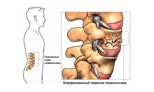 Причини, признаци и лечение на наранявания и наранявания на гръбначния мозък