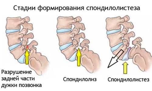 Причини, признаци и лечение на наранявания и наранявания на гръбначния мозък