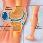 Конус под коляното отзад: снимка на патела, лечение