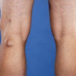 Конус под коляното отзад: снимка на патела, лечение