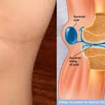 Течност в колянната става: какво да правите, когато коляното е групирано под калигата, симптоми, профилактика