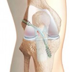 Как да се лекува частично разкъсване на връзките на колянната става (вътрешно, странично): възстановяване на коляното