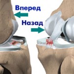 Как да се лекува частично разкъсване на връзките на колянната става (вътрешно, странично): възстановяване на коляното