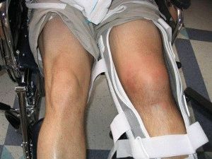 Симптоми и лечение на дислокация на колянната става