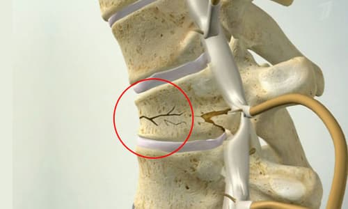 Симптоми, първа помощ, транспортиране и лечение на компресионна фрактура на гръбначния стълб