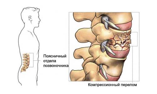 Симптоми, методи на лечение и възможни последствия от фрактури на гръбначния стълб