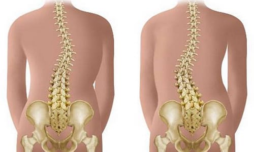Какви са симптомите, лечението и последиците от компресионната фрактура на гръбначния стълб при децата?
