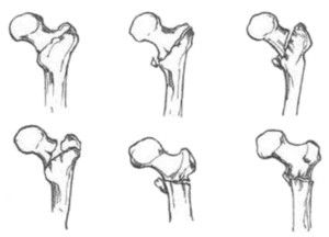 Вертикална фрактура на бедрената кост в напреднала възраст