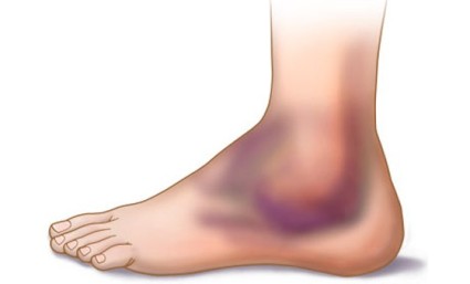 Натъртване на крака: признаци на проявление по отделения и методи на лечение