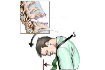 Причини и клинична картина на сублуксациите в гръбначния стълб