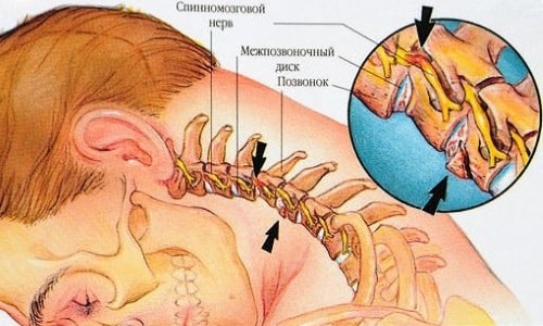 Причини, симптоми и лечение на фрактури на гръбначния стълб