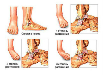 Клинична картина и лечение на изкълчването около коляното