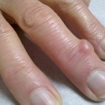 Конуси върху пръстите (голям, среден, индекс, малък пръст): как да се отървете и как да лекувате ставите