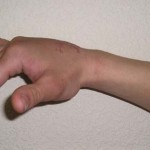 Контузия на китката: симптоми и лечение на наранявания на ръцете